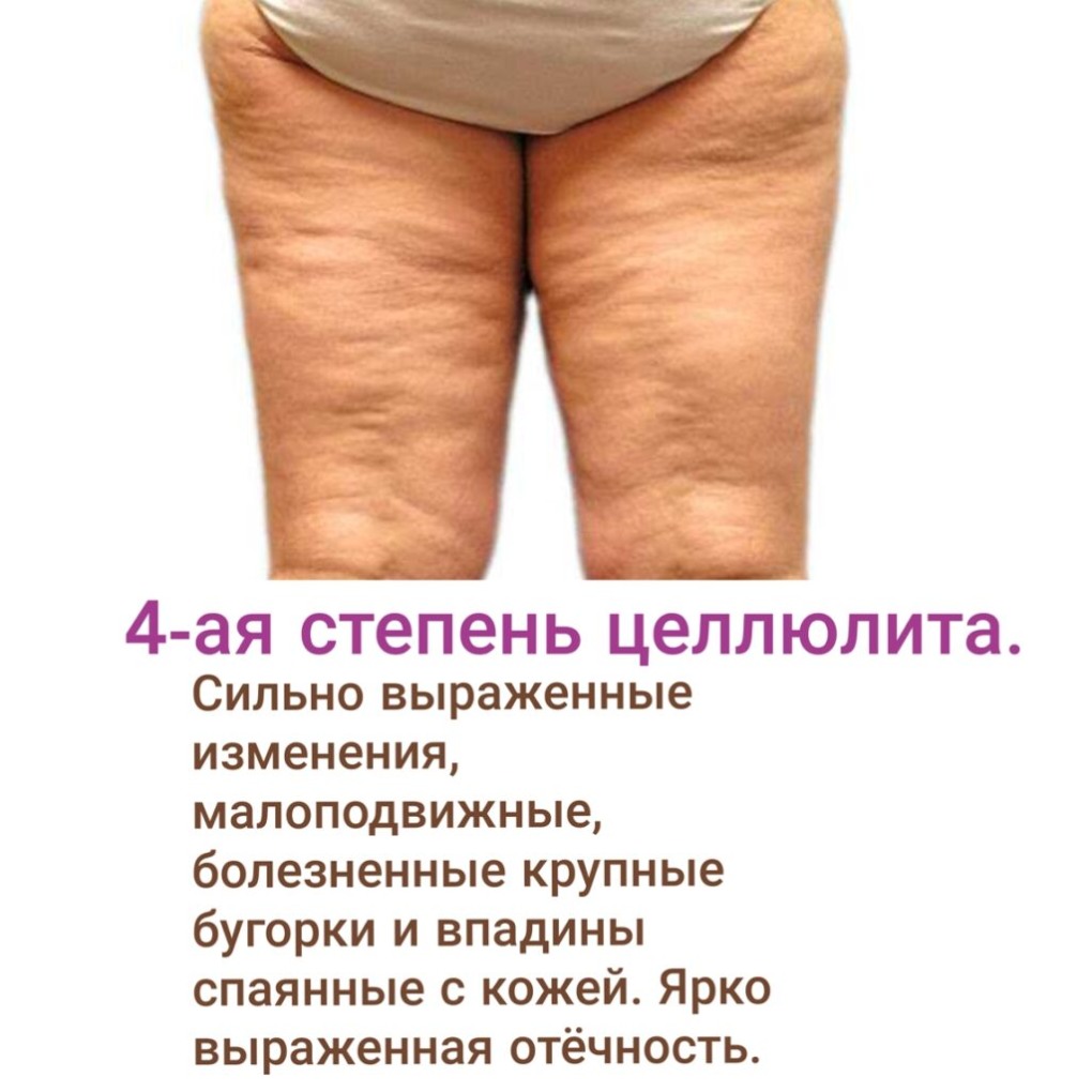 Четвертая стадия целлюлита